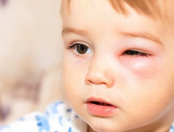 alergi mata pada anak